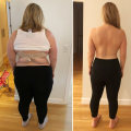 The Ultimate Guide to Weight Loss Surgery