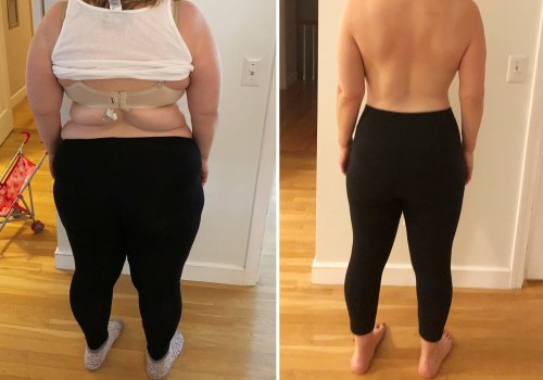 The Ultimate Guide to Weight Loss Surgery
